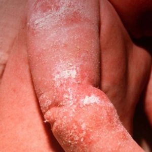 ceramol-hautpflege-atopische-dermatitis